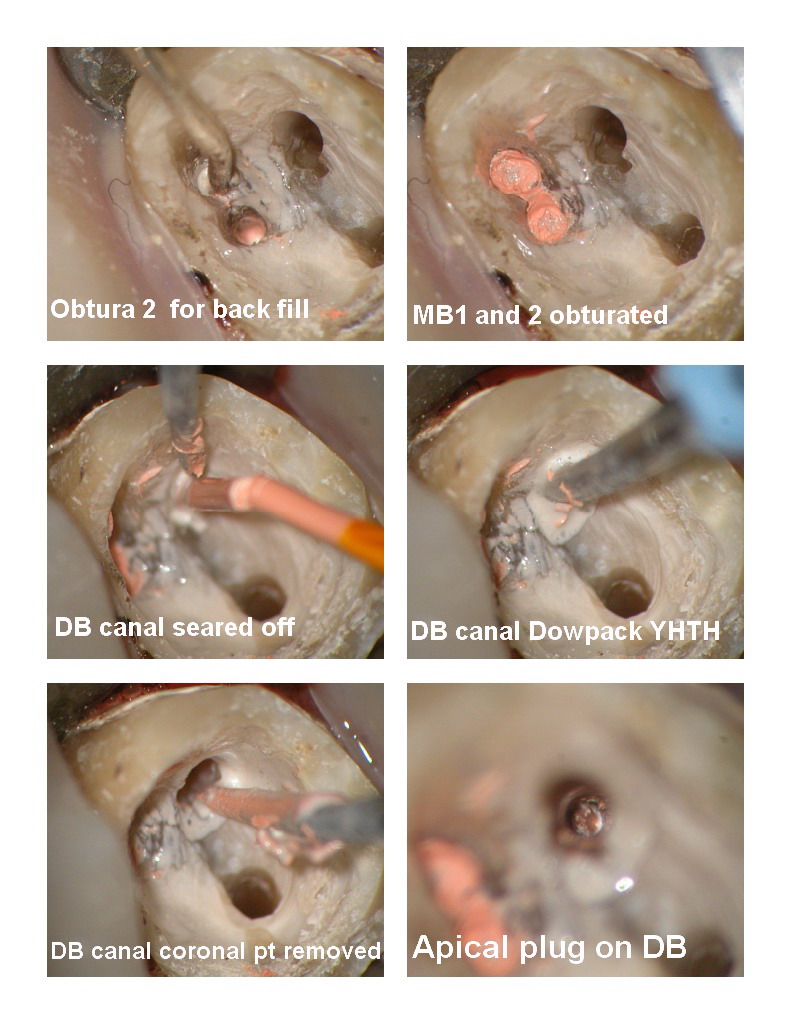 Endo first molar pg 2.jpg